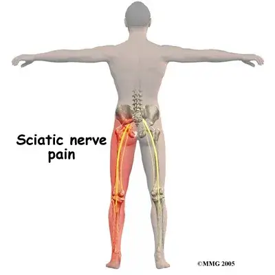 sciatica osteopathy Symptoms Sciatic Nerve Pain