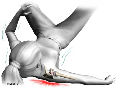 Causes of Acromioclavicular Joint Separation