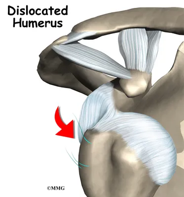Shoulder Instability Causes