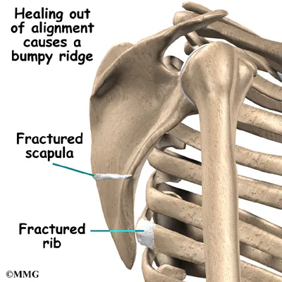 shoulder snap cause01