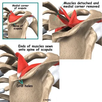 Shoulder Snap Surgery