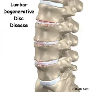 slipped disc 300x300 1 slipped disc 300x300 1