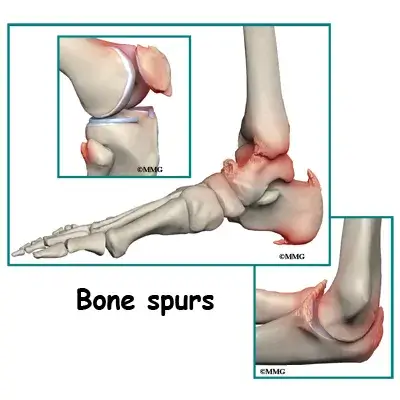 spine general DISH causes02 Causes and Risk Factors