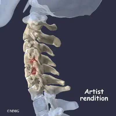 spondylo diagnosis01 spondylo diagnosis01