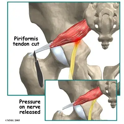 surgery for sciatica surgery for sciatica