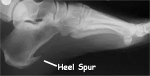 xray foot heelspur1 300x152 1