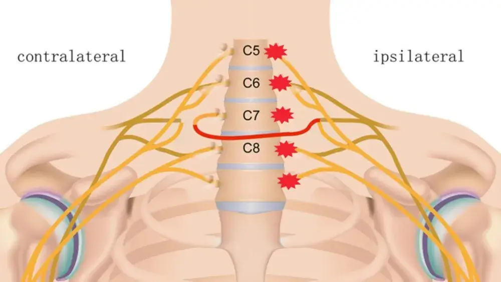 C7 Tothyroid gland bursa in the shoulders elbows C7 Tothyroid gland, bursa in the shoulders, elbows