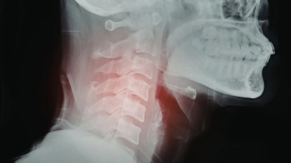 Cervical Spine Cervical Spine