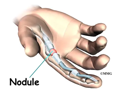 hand trigger digit causes01