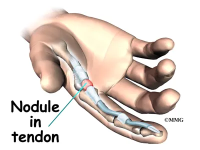 hand trigger digit symptoms01