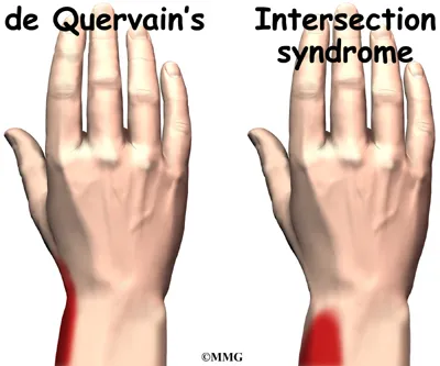 wrist intersection syndrome diagnosis01